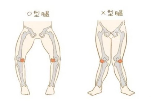 腿型矫正图示