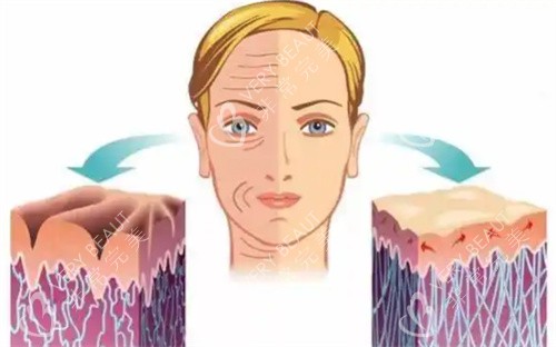 微拉美提升手术前后