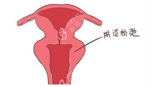 阴道松弛动画演示图