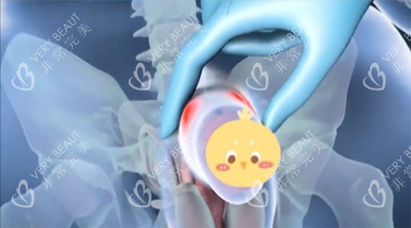 增大增粗手术照片 增大增粗手术照片