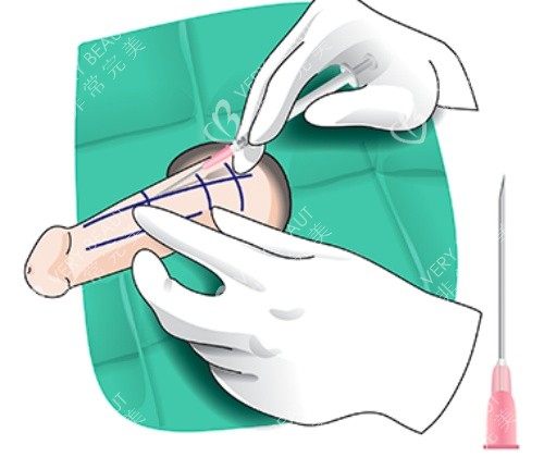 玻尿酸增粗漫画示意图 玻尿酸增粗漫画示意图