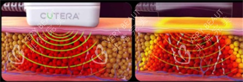 美国既塑3D溶脂操作过程 美国既塑3D溶脂操作过程