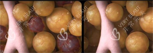 美国既塑3D溶脂前后脂肪细胞变化 美国既塑3D溶脂前后脂肪细胞变化