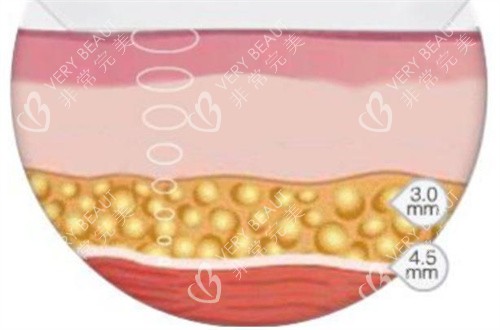 超声波溶脂演示动画图 超声波溶脂演示动画图