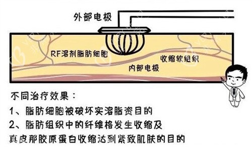 溶脂原理 溶脂原理