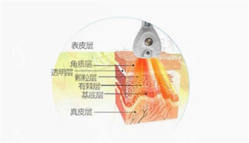 溶脂刀仪器可以深入到的层次图解 溶脂刀仪器可以深入到的层次图解