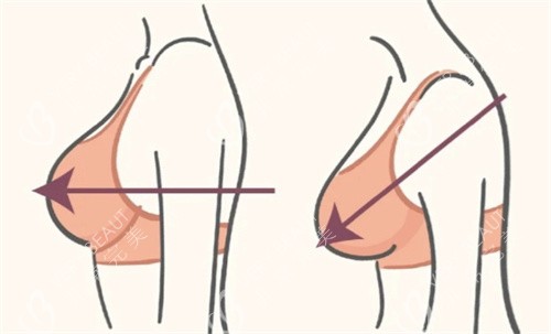 缩胸手术术前术后 缩胸手术术前术后