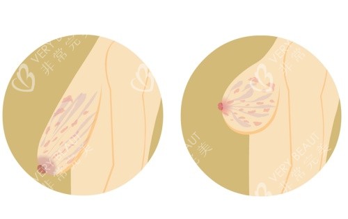 胸部下垂手术前后示意图 胸部下垂手术前后示意图