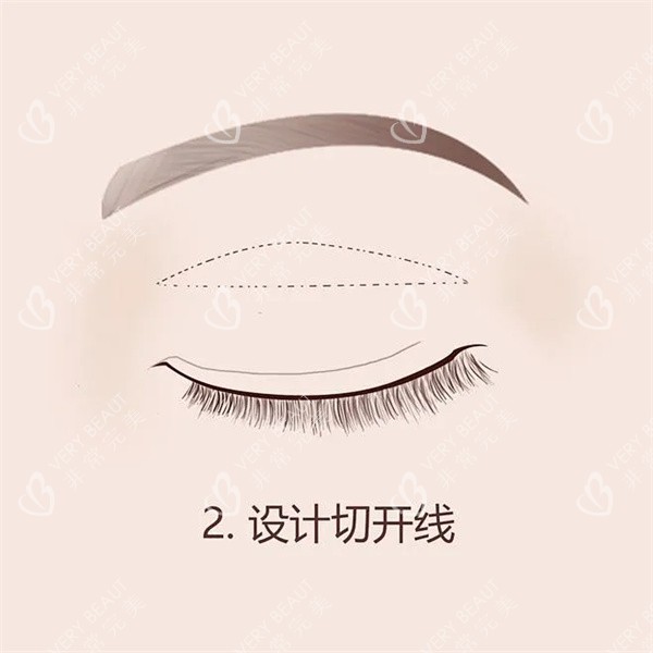 双眼皮手术 双眼皮手术