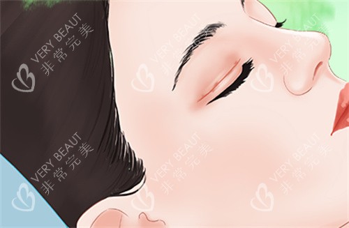 需要双眼皮修复的眼睛 需要双眼皮修复的眼睛