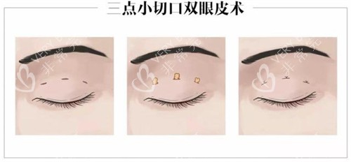 三点定位双眼皮的操作步骤 三点定位双眼皮的操作步骤