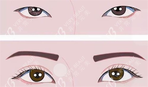 双眼皮前后对比 双眼皮前后对比
