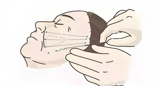 埋线提升图示 埋线提升图示