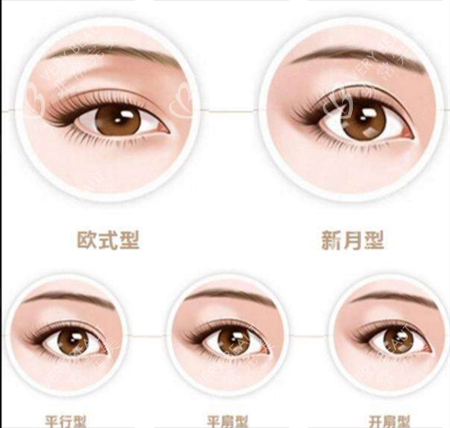 双眼皮类型图示 双眼皮类型图示
