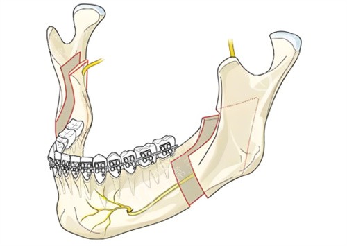 下颌角手术动画 下颌角手术动画