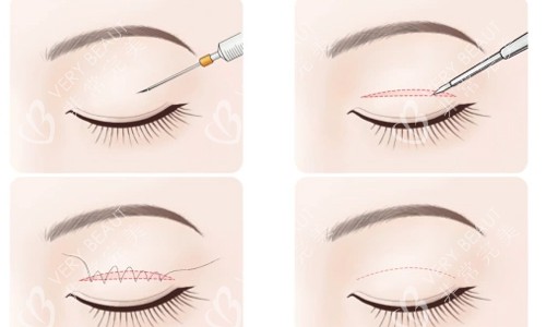 双眼皮埋线术后护理 双眼皮埋线术后护理