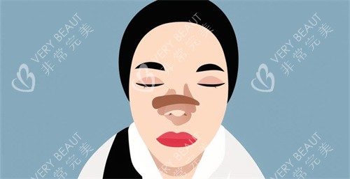 隆鼻手术后肿胀动画 隆鼻手术后肿胀动画