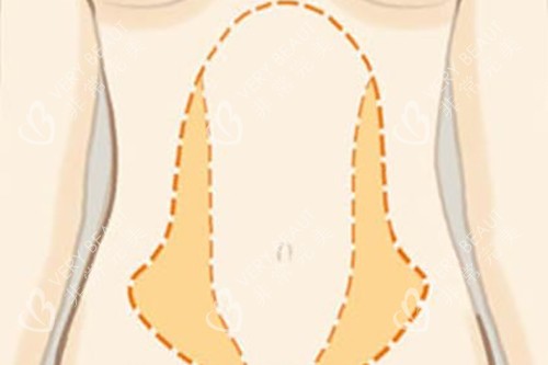 腰腹吸脂位置示意图 腰腹吸脂位置示意图
