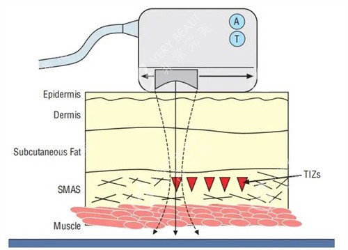 超声炮工作原理 超声炮工作原理