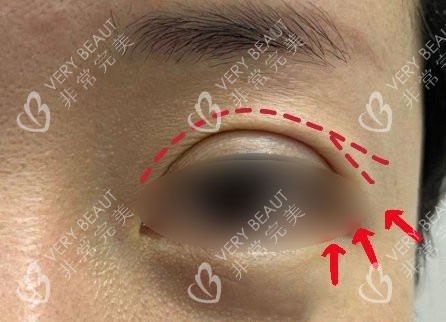 双眼皮眼尾开叉