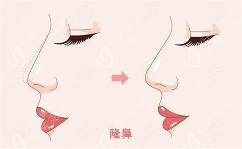 隆鼻术图