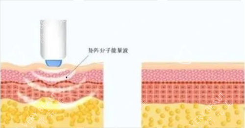 热玛吉项目皮肤剖面图