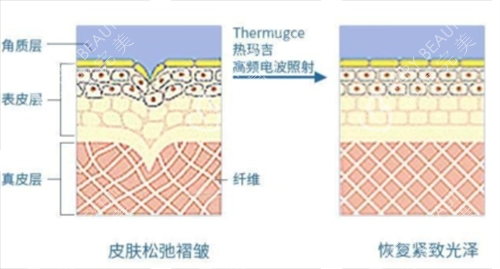 热玛吉作用在皮肤上皮下组织展示