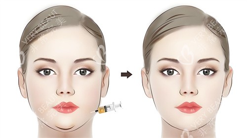 面部注射***前后对比动画图