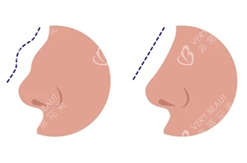 修复失败鼻子前后对比图