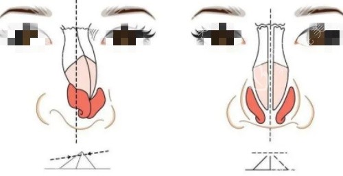 歪鼻修复矫正示意图