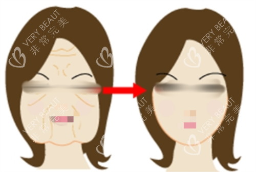 拉皮前后明显对比图