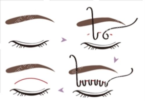 埋线双眼皮过程图示 埋线双眼皮过程图示