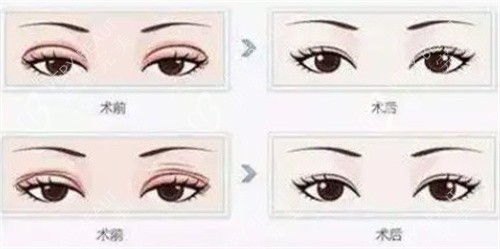 双眼皮修复 双眼皮修复