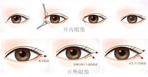 开眼角手术过程图 开眼角手术过程图