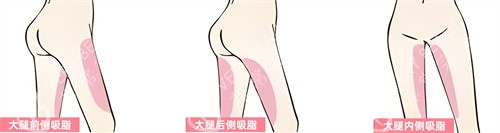 腿部吸脂部位展示动画图