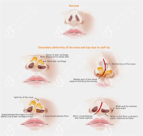 不同情况的鼻孔 不同情况的鼻孔