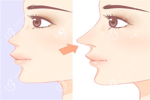 隆鼻手术前后展示图 隆鼻手术前后展示图