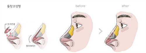 鼻子整形前后对比图 鼻子整形前后对比图