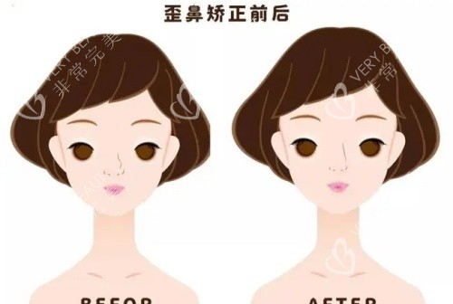 假体鼻子歪斜矫正前后示意图