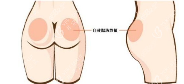 臀部塑形手术