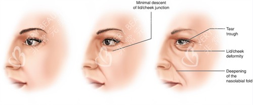 面部提升改善不同程度的面部老化 面部提升改善不同程度的面部老化
