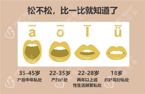 阴道松弛的程度对比 阴道松弛的程度对比