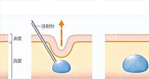 玻尿酸注射皮肤前后对比 玻尿酸注射皮肤前后对比