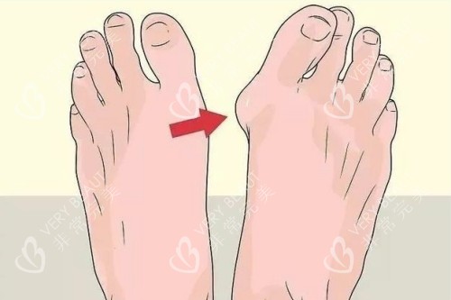 大脚骨整形前后对比图