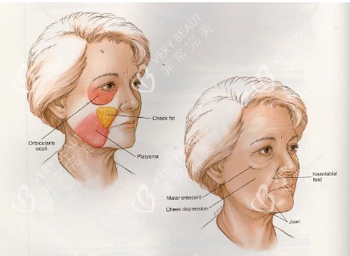 面部线提升对比
