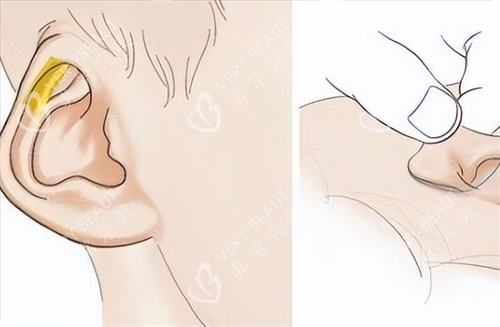 耳再造耳部畸形动画展示 耳再造耳部畸形动画展示