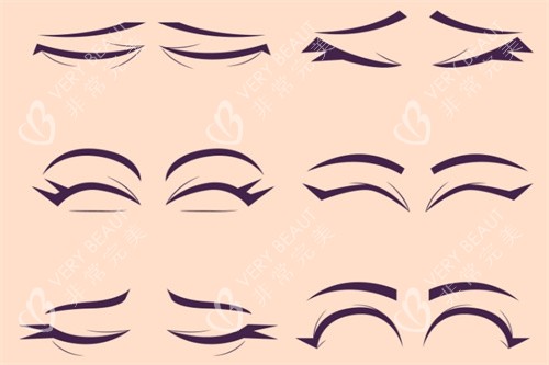 眼部整形术式对比