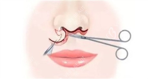 人中缩短 人中缩短