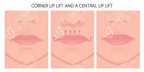 人中缩短手术动画图示 人中缩短手术动画图示