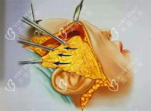 拉皮手术示意图.jpg 拉皮手术示意图.jpg